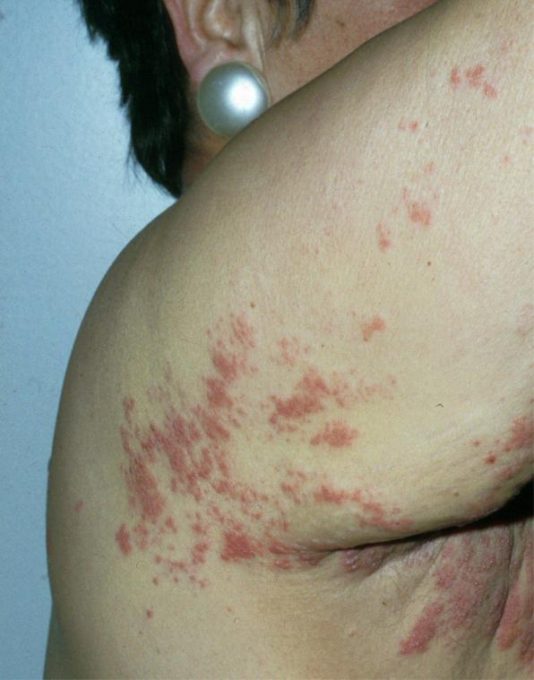 <p>Gürtelrose kann die Folge eines überlasteten Immunsystems sein.</p>