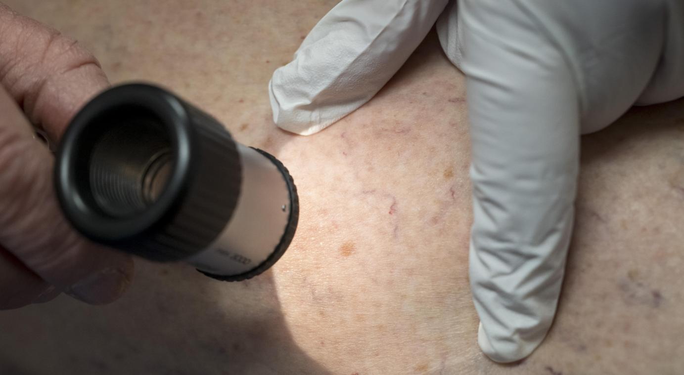 <p>Verbesserte Früherkennung und Diagnostik tragen dazu bei, dass Krebserkrankungen – etwa Hautkrebs – häufiger entdeckt werden.</p>