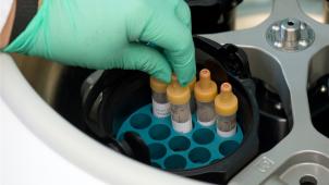<p>Bei einem vormals HIV-positiven Patienten sind 34 Monate nach einer speziellen Stammzelltransplantation keine Viren mehr nachweisbar.</p>