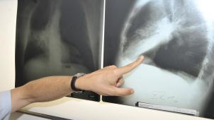 <p>Krebspatienten laufen Gefahr, Kollateralopfer der Coronakrise zu werden.</p>
