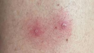 <p>Hautsymptome von Affenpocken-Patienten</p>