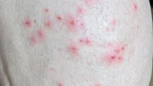 <p>Dieses vom Antwerpener Institut für Tropenmedizin zur Verfügung gestellte Foto zeigt Hautsymptome von Affenpocken-Patienten.</p>