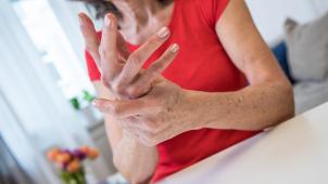 <p>Eine rheumatoide Arthritis zeigt sich oft zuerst durch Entzündungen in den Fingergelenken.</p>