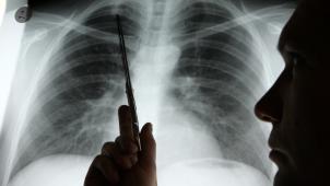 <p>Diagnose Lungenkrebs</p>