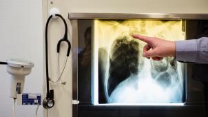 <p>Tuberkulose ist eine Infektionserkrankung, die in den meisten Fällen die Lunge betrifft.</p>
