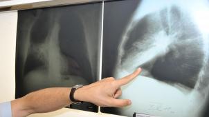 <p>Mehr Lungenkrebsfälle bei Frauen – auch ohne Rauchervergangenheit.</p>