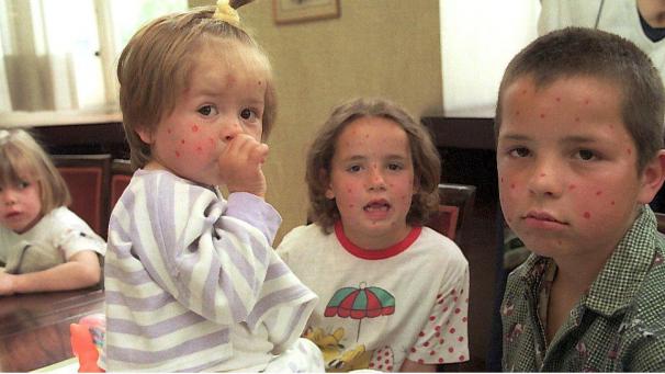 <p>Trotz der systematischen und kostenlosen Impfung seit 1995 treten Masern-Epidemien immer noch regelmäßig in Belgien auf.</p>