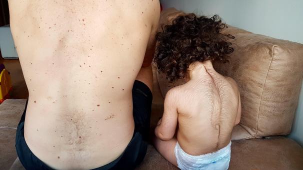 <p>Ein Mädchen, das vom „Werwolf-Syndrom“ (Hypertrichose) betroffen ist, nachdem es mit dem falschen Medikament behandelt wurde, sitzt neben seinem Vater.</p>