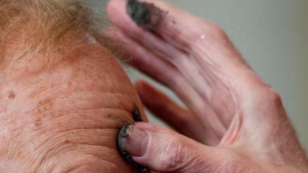 <p>Eine gut gemeinte Aschermittwochsaktion der Kirche im Eifelort Monschau hat offenbar zu Hautproblemen bei mehreren Gläubigen geführt.</p>