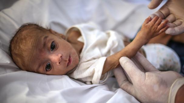 <p>Eine Krankenschwester hält die Hand eines schwer unterernährten Kindes auf der Intensivstation (ICU) des Ibn Sina Krankenhauses, um seinen Zustand zu überwachen: Die Abteilung für Unterernährung im Ibn Sina Krankenhaus hat im letzten Monat mehr als 374 Fälle behandelt, und mehr als 5.000 Fälle im Jahr 2020.</p>