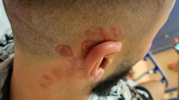 <p>Nur eine der Verletzungen, die die Schlägerei zur Folge hatten.</p>