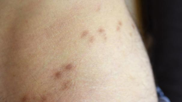 <p>Krätze kann in vielen Fällen Narben hinterlassen.</p>