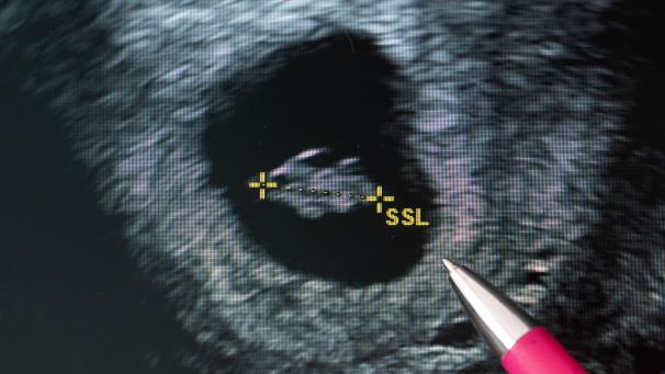 <p>Eine Frauenärztin deutet auf den Fötus im Ultraschallbild.</p>