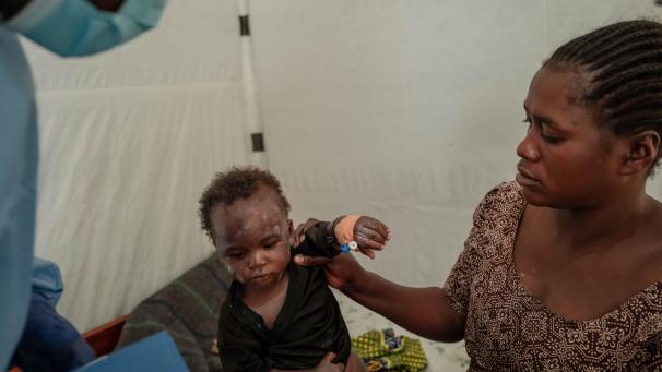 <p>Mpox-Behandlung eines Kindes in einem Krankenhaus in Goma, Kongo</p>