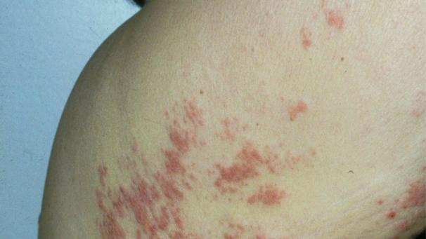 <p>Gürtelrose kann die Folge eines überlasteten Immunsystems sein.</p>