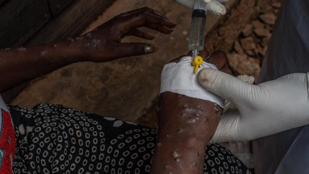<p>Behandlung einer Mpox-Patientin in einem Krankenhaus im Kongo.</p>