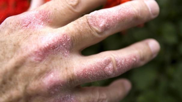 <p>Schuppenflechte an einer Hand</p>